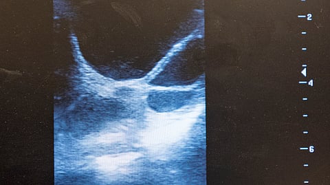 Normaalisti kehittynyt follikkeli.