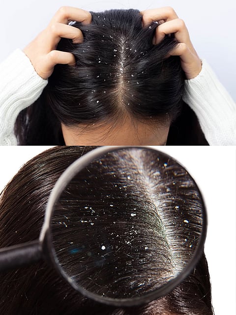 What are the simple remedies for dandruff