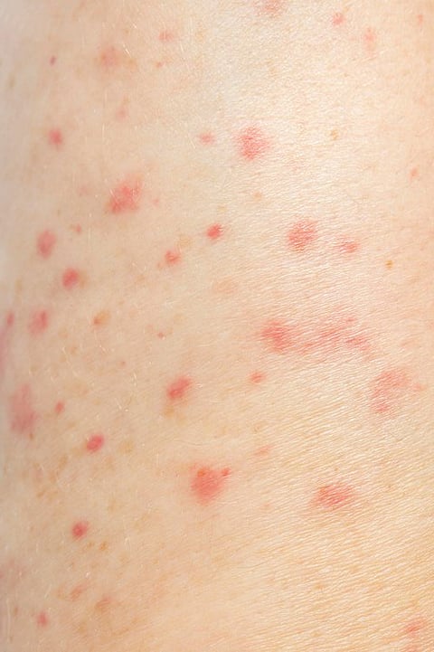 Chicken Pox facts