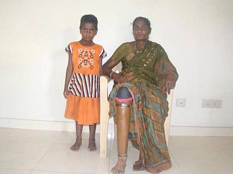 செயற்கைக் கால்களால் நிமிர்ந்து நிற்கிறேன்!