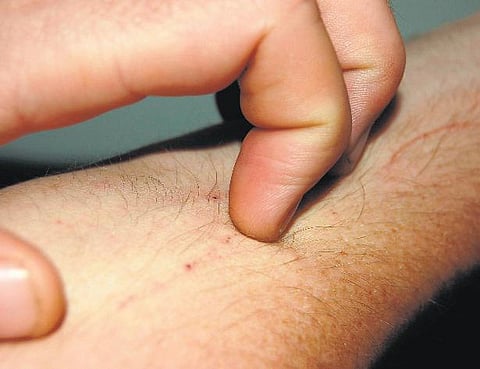 மெல்லத் தமிழன் இனி...! 30 - மனிதத் தோலுக்குள் ஊடுருவும் பூச்சிகள்!