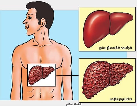 மெல்லத் தமிழன் இனி... 35 - கல்லீரல் இழைநார் வளர்ச்சி நோய்: மது நோய்களின் உச்சம்!