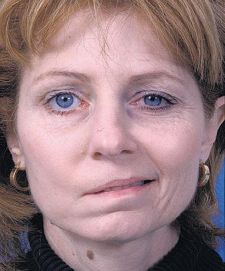 பெண்களைத் தாக்கும் முகவாதம் - மார்கழி முன்னெச்சரிக்கை