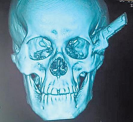 தலையில் பாய்ந்த கத்தியுடன் 2 மணி நேரம் கார் ஓட்டிய நபர்﻿: அதிர்ஷ்டவசமாக உயிர் தப்பினார்