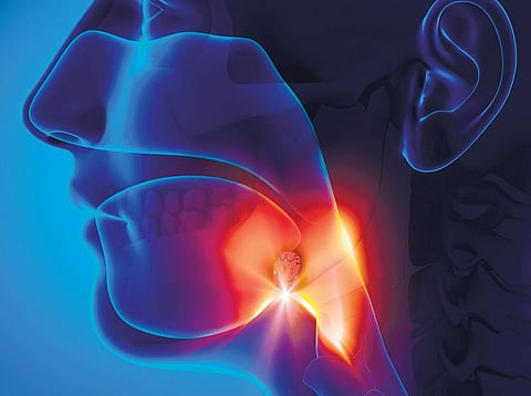 டான்சிலுக்கு அறுவை சிகிச்சைதான் தீர்வா?