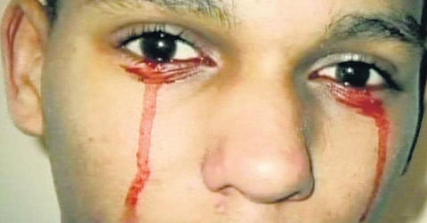 உறவில் திருமணத்தால் வரும் ரத்தம் உறையாமை﻿