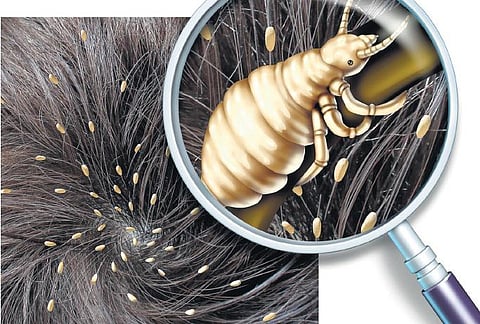 பேனை ஒழிக்க நல்ல மருந்து உண்டா?﻿