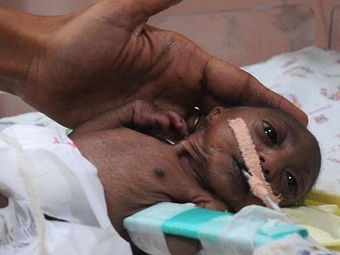 அரிதினும் அரிதான நோயால் பாதித்த 16 நாள் குழந்தைக்கு உதவும் மும்பை மருத்துவமனை