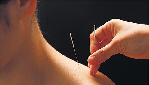 கேளாய் பெண்ணே: ஆறு மாதத்தில் அக்குபங்க்சர்﻿