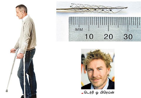 முடக்குவாதத்தை நீக்கும் செயற்கைத் தண்டுவடம்﻿