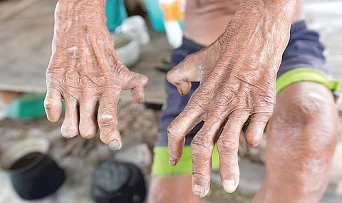 தொழுநோய்: மாற்றத்தின் தொடக்கமாவோம்!﻿