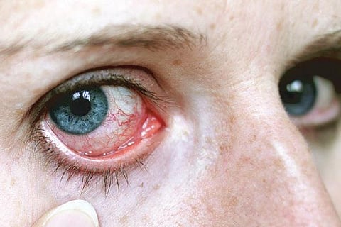 4 நல்ல வார்த்தை: கண் அரிப்பைப் போக்க...﻿