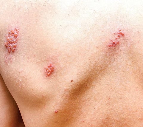 நலம் நலமறிய ஆவல்: பத்து ஆண்டுகளாக அக்கித் தொந்தரவு?