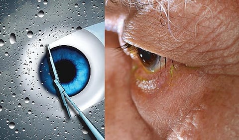 மறைந்திருந்து தாக்கும் கிளாகோமா﻿