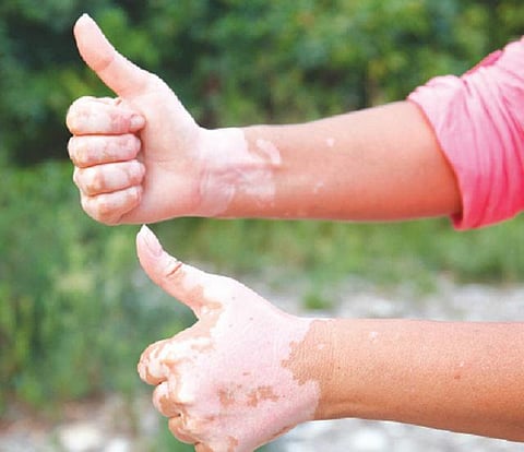 இணையகளம்: வெண்புள்ளிகள் நோய் அல்ல!﻿