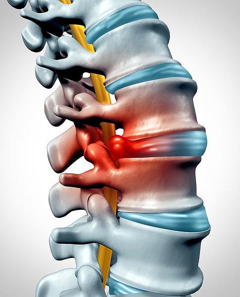 வாசகர் பகிர்வு: உங்களுக்கு இருக்கா ‘டிஸ்க் பல்ஜ்’?