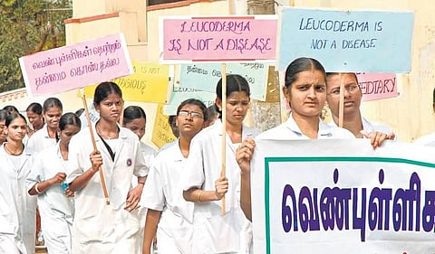 வெண்புள்ளிகளுக்கு இலவச சித்த மருத்துவ முகாம்:  தாம்பரத்தில் நடைபெற்றது