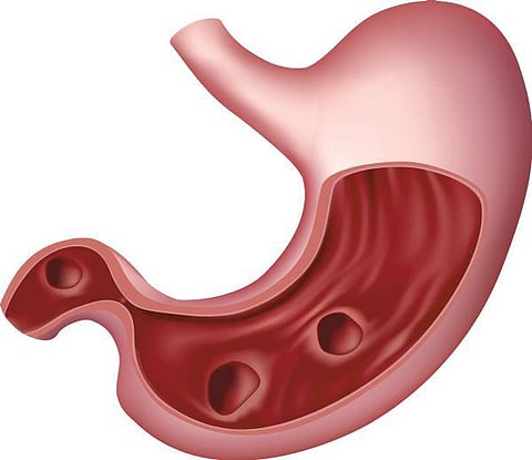 நலம் நலமறிய ஆவல் 10: அமிலச் சுரப்பால் அதிகப் பசியா?