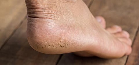 நலம் நலமறிய ஆவல் 19: பித்த வெடிப்பு போகாதா?