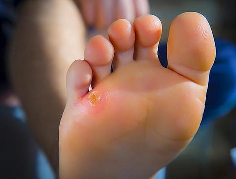 நலம் நலமறிய ஆவல் 21: கால் ஆணிக்கு ஆபரேஷன் தேவையா?