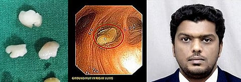 மதுரை வேலம்மாள் மருத்துவமனையில் சாதனை: முதியவரின் நுரையீரலில் சிக்கிய நிலக்கடலை அகற்றப்பட்டது