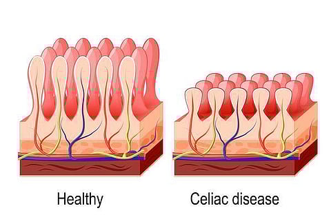 நலம், நலமறிய ஆவல் 34: சப்பாத்தி சாப்பிட்டால் அலர்ஜியா?