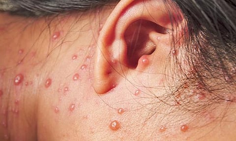 நலம், நலமறிய ஆவல் 41: சிற்றம்மையின் ‘ஸ்லீப்பர்’ அம்மை