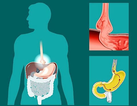 நலம், நலமறிய ஆவல் 43: ஏறிய இரைப்பை இறங்குமா..?