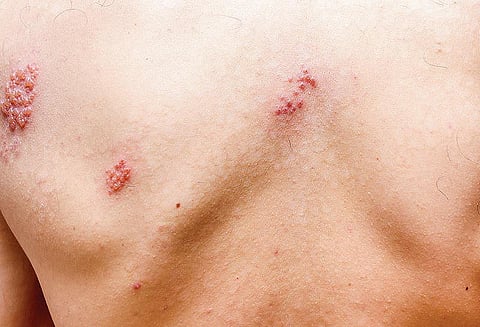 மீண்டும் பரவும் தொழுநோய்