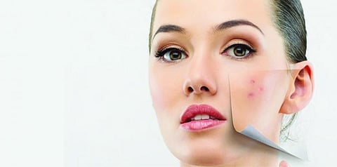 இனி எல்லாம் நலமே 12: பருவ வயதில் மட்டும்தான் பருக்கள் தோன்றுமா?