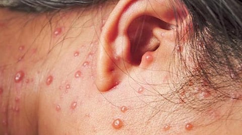 ஆடியில் மிரட்டும் அம்மையை விரட்ட வேப்பிலை போதும்! கூடவே கொஞ்சம் கேழ்வரகும், பாசிப்பருப்பும்!!