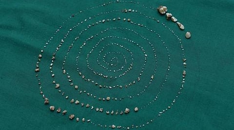 சிறுவனின் வாயிலிருந்து அகற்றப்பட்ட பற்கள்