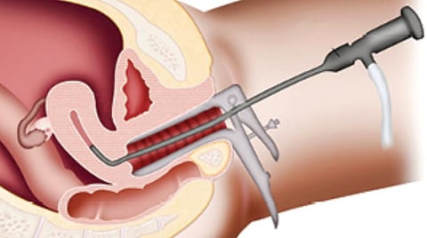 இனி எல்லாம் நலமே 35: தழும்பில்லாத அறுவை சிகிச்சை