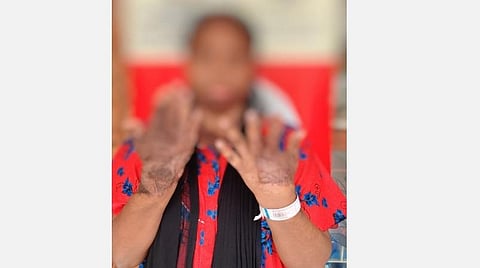 கோவை மெட்ரோபோலிஸ் ரோட்டரி சங்கம், கங்கா மருத்துவமனை சார்பில் செயல்படுத்தப்படும் திட்டத்தில் பயனடைந்த பெண்.