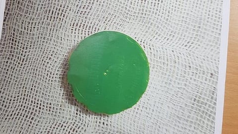 9 மாத குழந்தையின் தொண்டையில் சிக்கிய தைல பாட்டில் மூடி: காப்பாற்றிய மதுரை அரசு மருத்துவமனை மருத்துவர்கள்