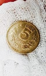 சிறுமி தனுசுயாவுக்கு சிகிச்சை அளித்த மருத்துவக் குழுவினர். அடுத்த படங்கள்: சிறுமி தனுசுயா. உணவு குழாயில் சிக்கியுள்ள நாணயம். கடைசிப்படம்: தனுசுயா விழுங்கிய 5 ரூபாய் நாணயம்.