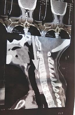 மூதாட்டியின் உணவு குழாயில் கோழி எலும்பு சிக்கி கொண்டிருப்பது ஸ்கேன் பரிசோதனையில் உறுதியானது. அடுத்த படம்: எண்டோஸ்கோப் மூலம் அகற்றப்பட்ட கோழி எலும்பு மற்றும் இறைச்சி.