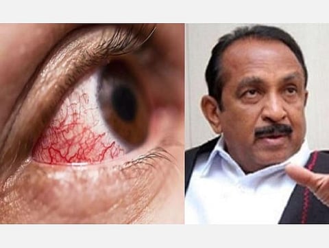 அடுத்த தாக்குதல்: கருப்பு பூஞ்சை நோய், ஆயத்தம் ஆவோம்: வைகோ எச்சரிக்கை