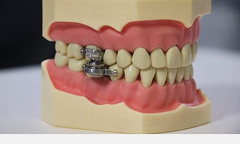 டென்டல்ஸ்லிம் டயட் கண்ட்ரோல்: எடையை இழக்க வைக்கும் புதிய கருவி