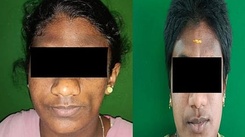 சிகிச்சைக்கு முன் மற்றும் சிகிச்சைக்கு பிந்தைய பெண்ணின் தோற்றம்