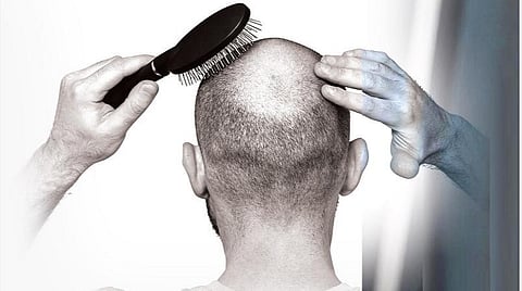 முடி உதிரும் பிரச்சினைக்குப் புதிய விடியல்!