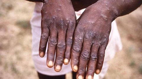 Monkeypox | 12 நாடுகளை சேர்ந்த 92 பேர் பாதிப்பு: உலக சுகாதார அமைப்பு