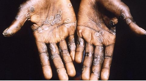 குரங்கு அம்மை தடுப்பு நடவடிக்கை: மத்திய சுகாதாரத்துறை செயலர் ஆலோசனை 