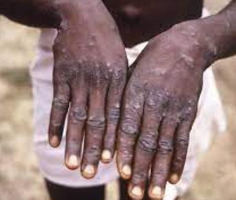 டெல்லியில் ஒருவருக்கு குரங்கம்மை உறுதி: இந்தியாவில் 4 பேருக்கு பாதிப்பு