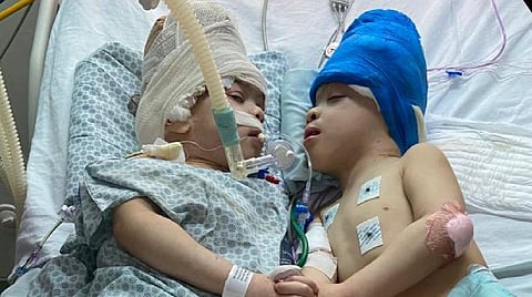 100 பேர் கொண்ட மருத்துவக் குழு 27 மணி நேரம் தொடர்ச்சியாக 9 அறுவை சிகிச்சை: பிரேசிலில் தலை ஒட்டிப் பிறந்த இரட்டையர் பிரிப்பு