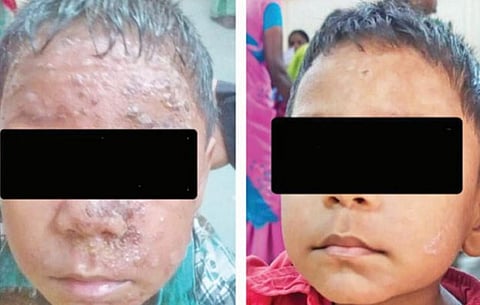 காட்டுமன்னார்கோவில் அரசு மருத்துவமனைக்கு அக்கி பாதிப்புடன் வந்த சிறுவன் சிகிச்சைக்கு பின்னர் பழைய முகத்தோற்றத்துடன் உள்ளது.