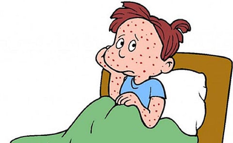 ஓசூர் பகுதியில் குழந்தைகளுக்கு பரவும் அம்மை நோய் - சுகாதாரத் துறை அலர்ட்