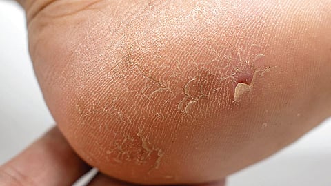 டாக்டர் பதில்கள் 31: பாத வெடிப்புக்கு என்ன காரணம்?