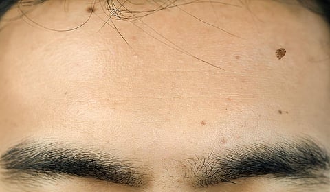 டாக்டர் பதில்கள் 45: கொழுப்புக் கட்டிகள் ஆபத்தில்லையா?