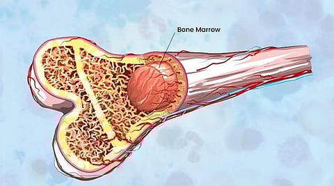 எலும்பு மஜ்ஜை மாற்றுச் சிகிச்சை எல்லோருக்கும் கிடைப்பது எப்போது?